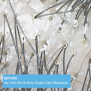As I Am dry itchy scalp dandruff shampoo 355ml tea tree olive oil cleansing hydrating anti dandruff scalp care