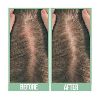 Tea tree hair oil for itchy scalp relief, strengthening and healthy refreshed hai